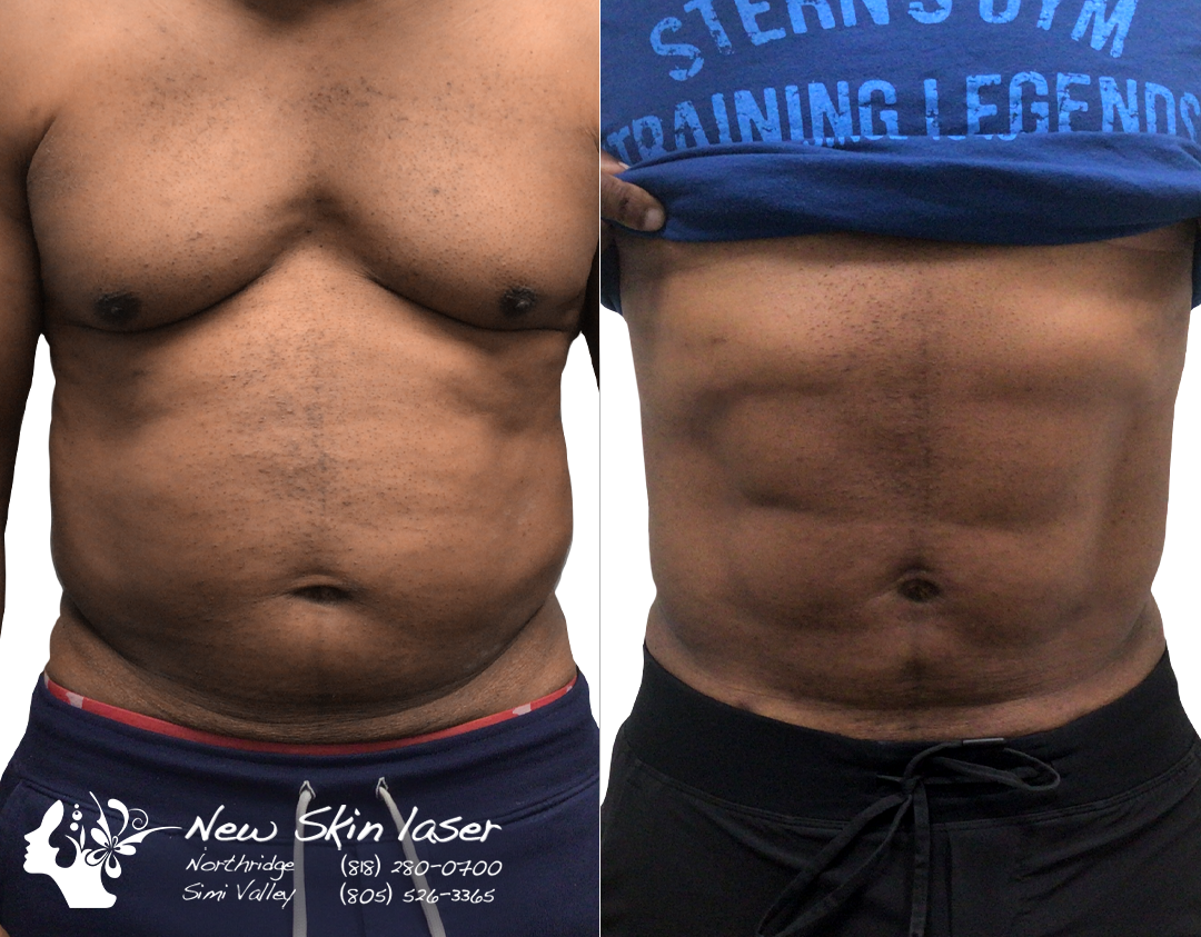 New Skin Laser Center in Los Angeles, CA