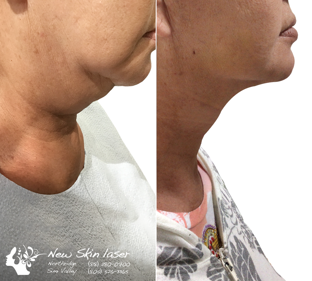 New Skin Laser Center in Los Angeles, CA