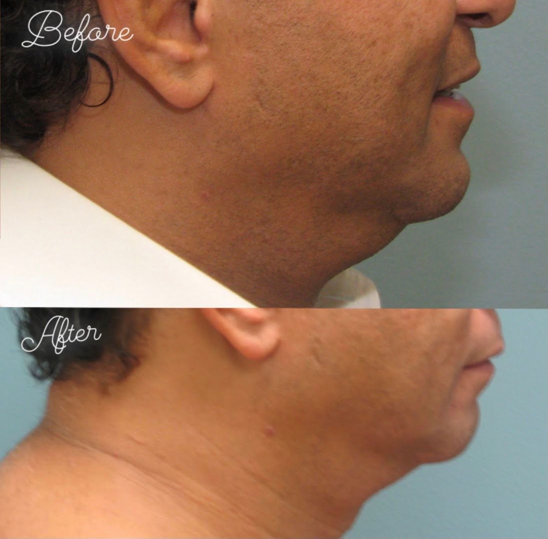 Beverly Hills Lipo in Beverly Hills, CA
