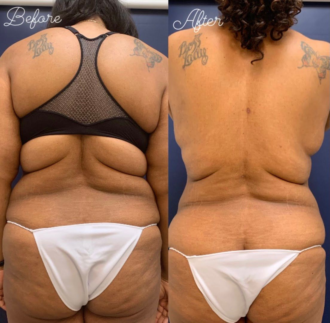 Beverly Hills Lipo in Beverly Hills, CA