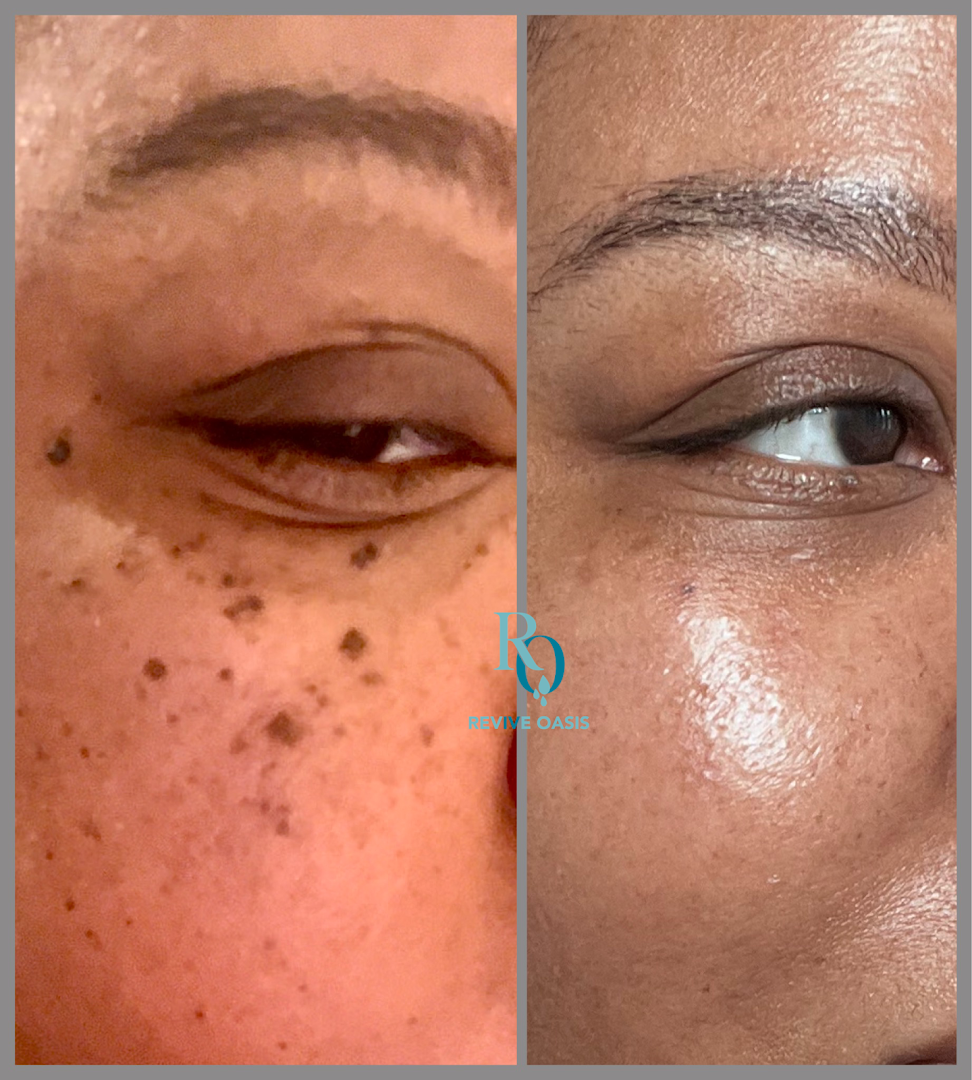 Revive Oasis Hydration and Skin Renewal in St Petersburg, FL
