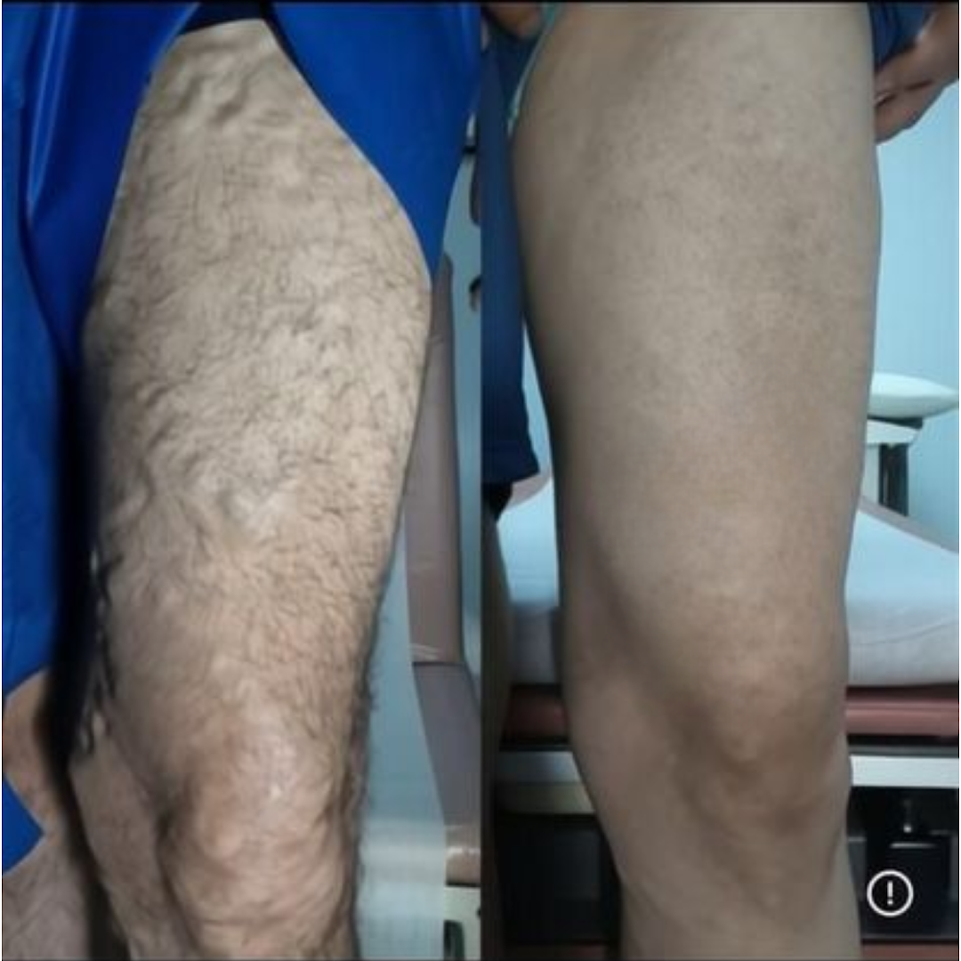 Varicose Vein Laser Center and Med Spa in Montebello, CA